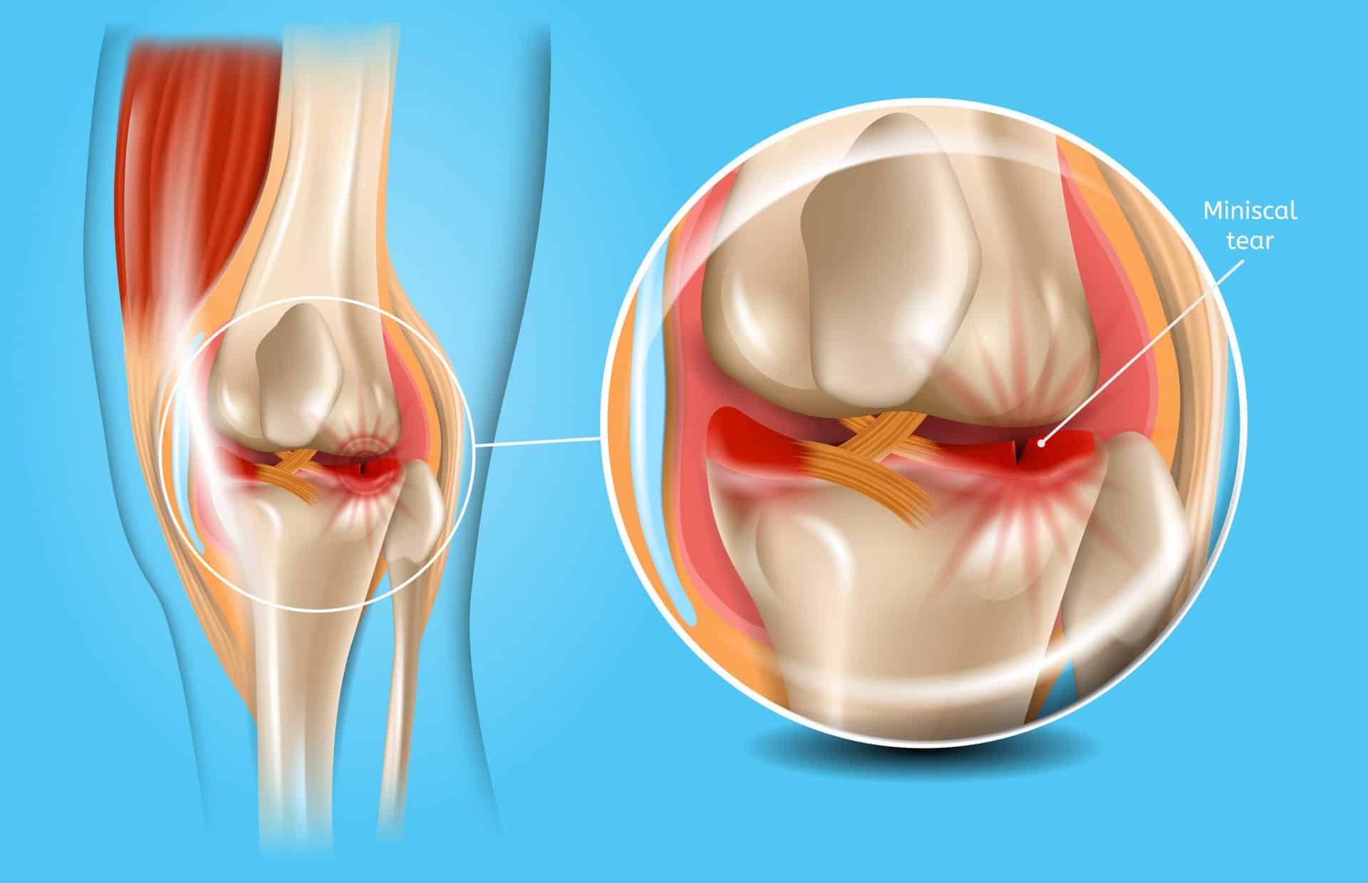 Two weeks after meniscus root repair